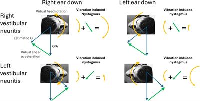 Amplification of vibration induced nystagmus in patients with peripheral vestibular loss by head tilt